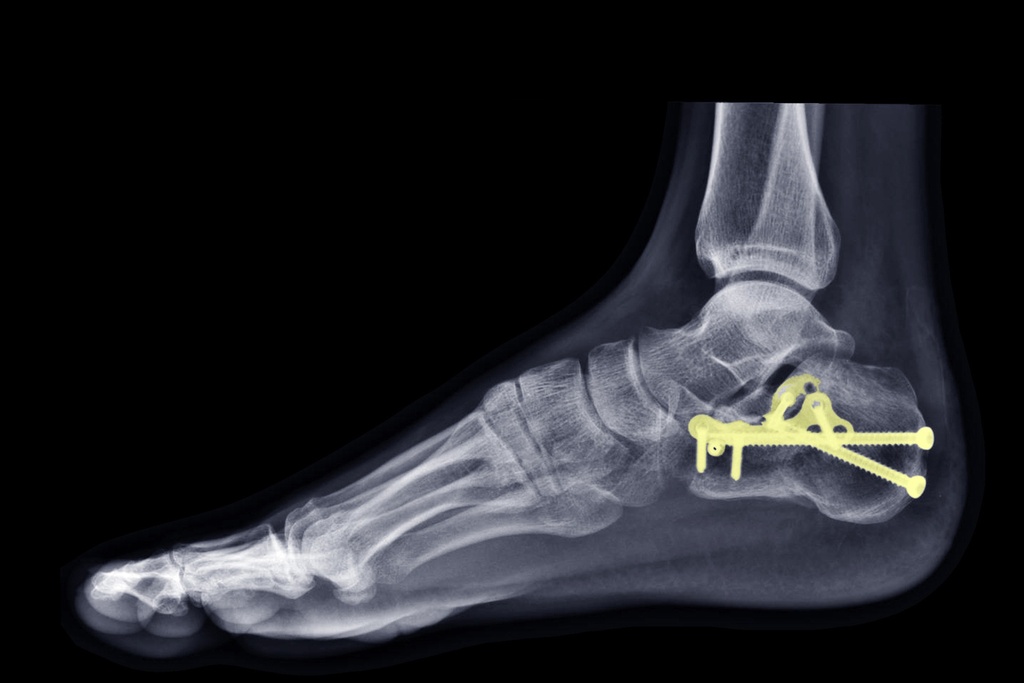 Arthrodesen und Knochenrekonstruktionen am Fuß mit der Shark Screw